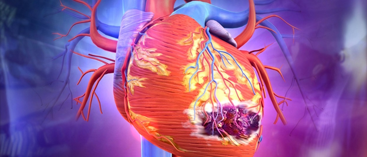 acute-myocardial-infarction.jpg